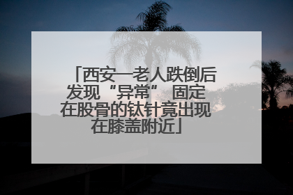 西安一老人跌倒后发现“异常” 固定在股骨的钛针竟出现在膝盖附近